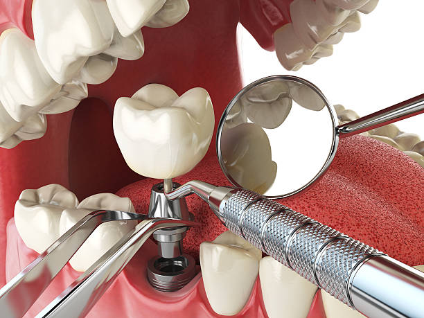 Best Root Canal Emergency Dentist  in Clarkston, WA